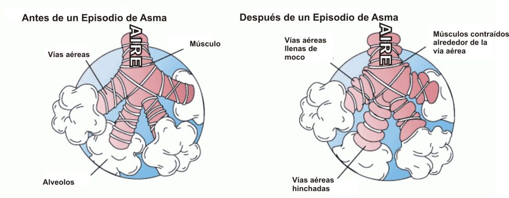 Qué sucede antes y después de un episodio de asma