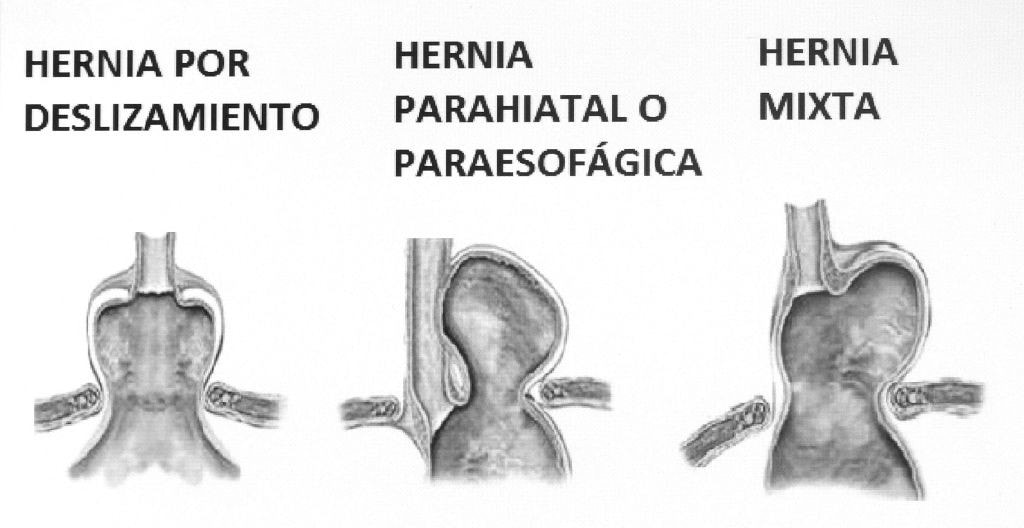 Se pueden producir tres tipos de hernias hiatales, mixtas, por deslizamiento o paraesofagicas