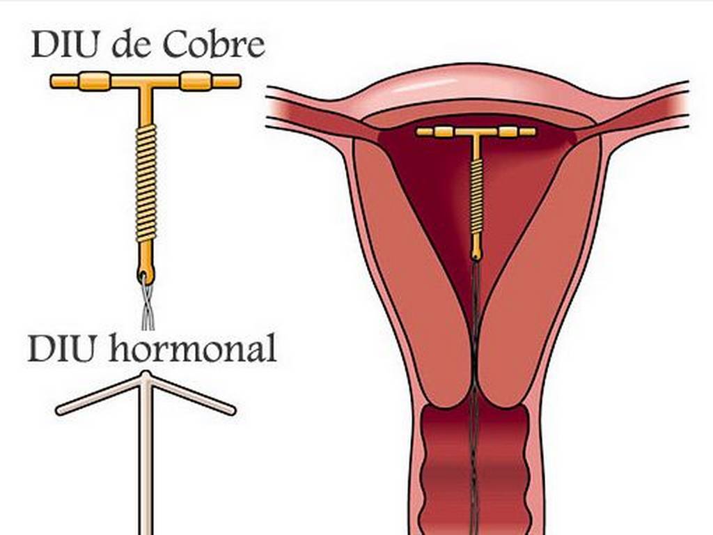 Diferencias fisicas entre el diu de cobre y el hormonal