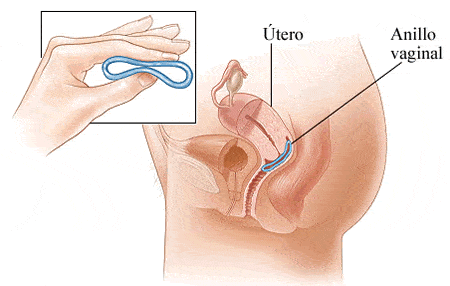 El anillo vaginal debe doblarse e introducirse hasta el fondo del utero, donde permanecera 3 semanas