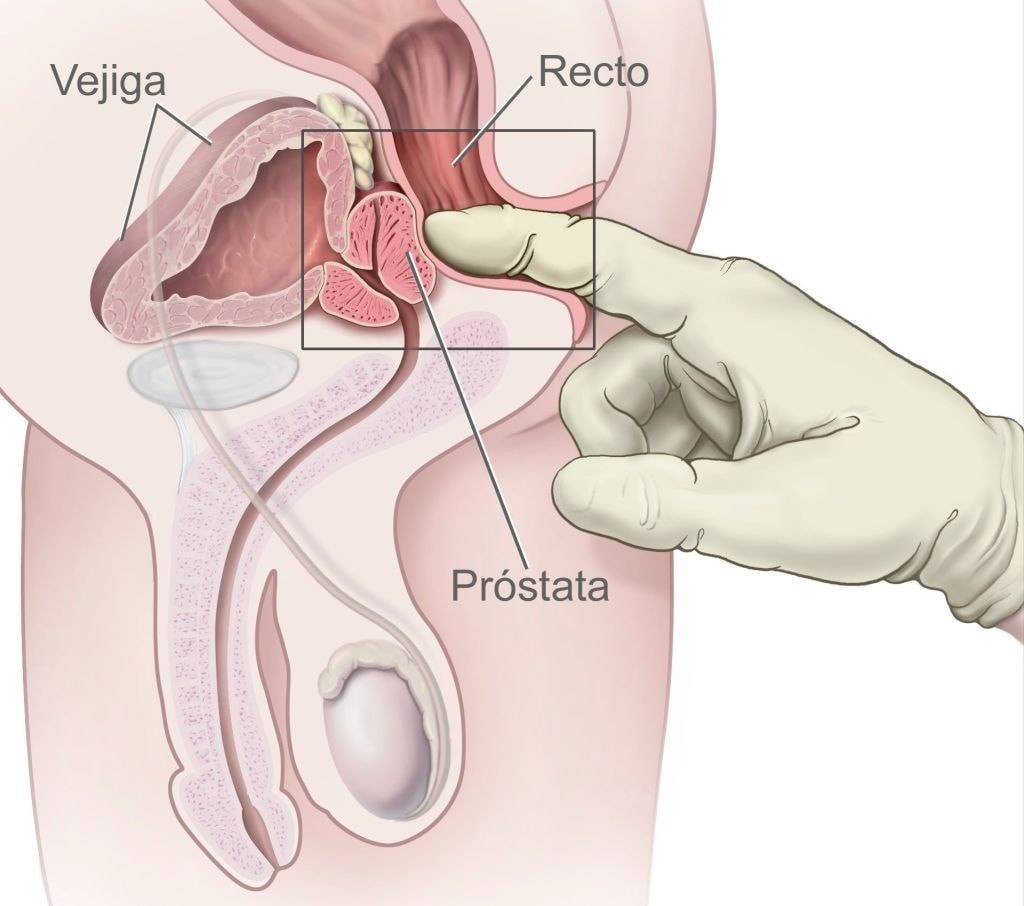 El medico especialista puede acceder a la prostata a traves del recto, con el fin de comprobar su estado