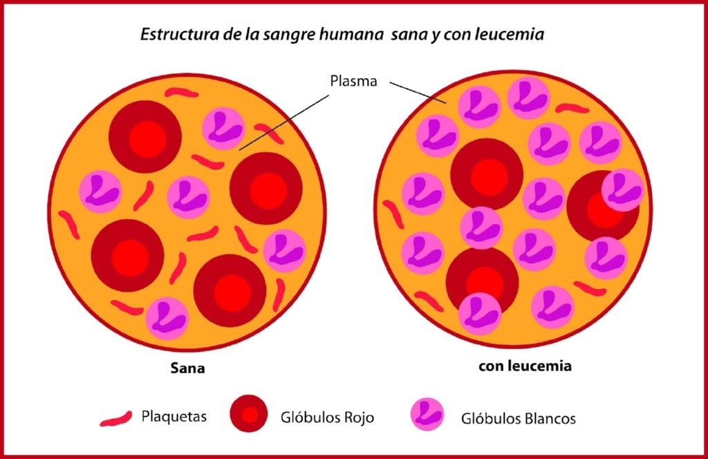 Comparacion de una celula sana con una con leucemia. Fuente: bioygeo3.wordpress.com