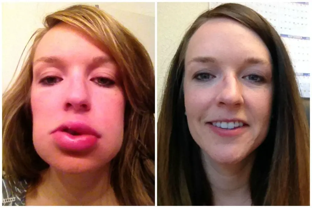 Comparacion, a la izquierda chica con un angioedema, a la derecha la misma chica despues de haber tratado esta alergia