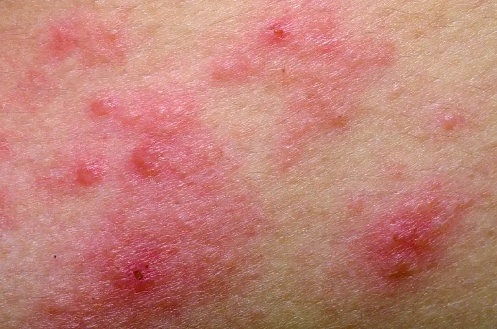Ejemplo de dermatitis atopica