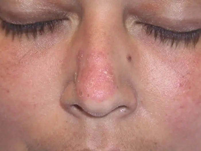 El-lupus-es-una-enfermedad-que-no-tiene-tratamiento-para-su-eliminacion-solo-para-aliviar-sus-sintomas.jpg El lupus es una enfermedad que no tiene tratamiento para su eliminación, solo para aliviar sus síntomas.jpg