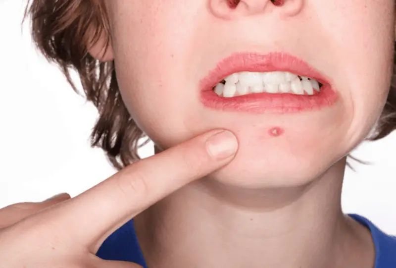reventar espinilla es peligroso acne