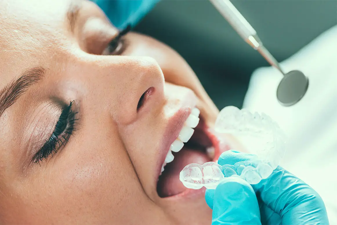 tratamiento de blanqueamiento dental