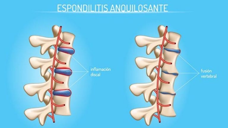 Espondilitis Anquilosante Qué es y a qué órganos afecta Como Funciona Que