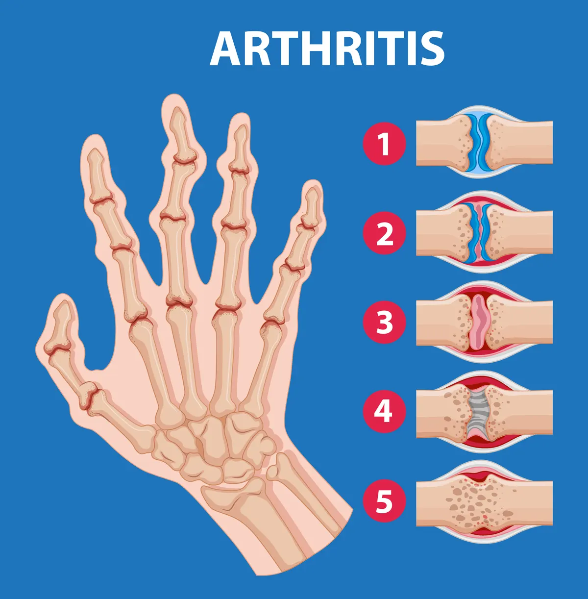 artritis