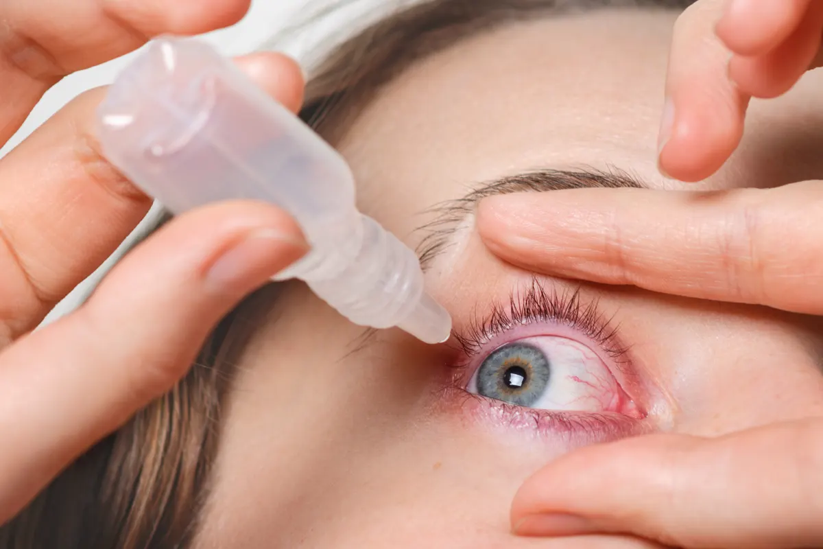 de-cerca-la-mujer-vierte-gotas-en-los-ojos-rojos-tiene-conjuctivitis-o-glaucoma-mala-vista-y-dolor-concepto-de-tratamiento-del-dolor-de-ojos-mujer-cura-ojo-rojo-sangre