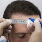 Implante capilar: todo lo que debes conocer en este procedimiento implante capilar