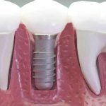 ¿Qué tipos de implantes dentales existen y son eficaces?
