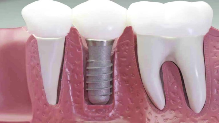 Qué tipos de implantes dentales existen y son eficaces Como