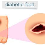 Pie diabético: qué es y qué calzado elegir